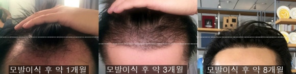 모발이식 후 결과는 언제 볼 수 있을까? 관련 이미지 4