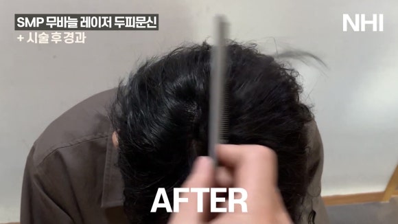 정수리 탈모 두피문신 전후 사진 / 영상 관련 이미지 3