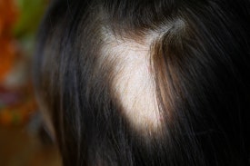 여드름치료제 복용 중 탈모가 생긴다면? 원인과 관리법 정리 관련 이미지 4