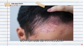 두피 가려움 원인, 갑자기 머리가 가려운 이유는 무엇인가요? [FAQ] 관련 이미지 3