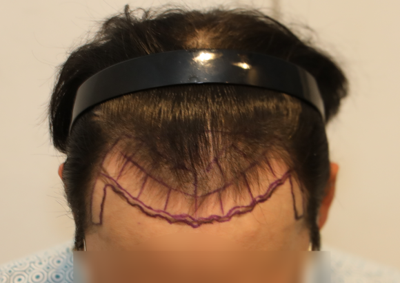 Hair Loss Treatment: Different Strategies by Area (When Combination Treatment Is Used) image 1