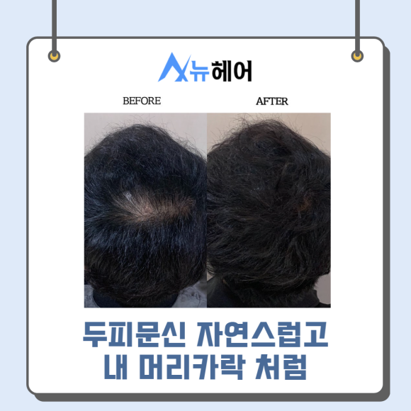 두피문신가격과 따져봐야 할 것은? 관련 이미지 5