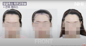 이마축소! 얼굴 작아지는 헤어라인교정 l 여자 모발이식 전후 사진 보기 관련 이미지 1