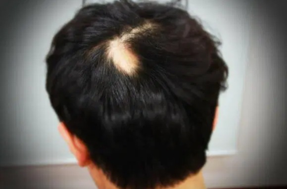 원형 탈모, 원인과 치료방법 관련 이미지 1