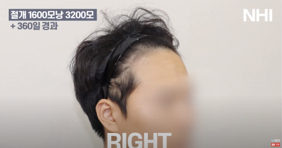 남자 모발이식 1600모낭 1년 지난 후 사진 경과 후기 관련 이미지 4