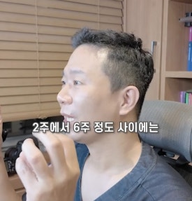 모발이식 후 머리 빠짐, 생착 실패일까? 암흑기·밀도·붉은기 관련 이미지 2