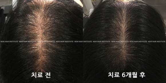 탈모치료(모낭주사) 효과 l 6개월 경과 사진 관련 이미지 1