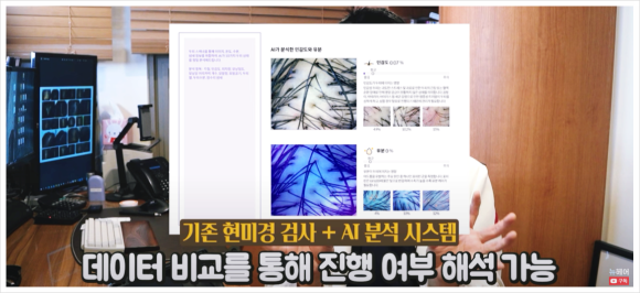 탈모진단비용? 17년 차 의사가 속시원히 알려줍니다 관련 이미지 3