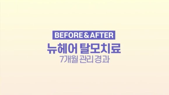 정수리탈모 엑소좀관리 7개월 경과 전후사진 관련 이미지 1