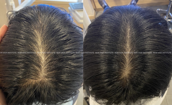 탈모주사 효과 궁금하시죠? 1년 동안 모낭주사 맞은 전후사진 공개ㅣ정수리 탈모 관련 이미지 1