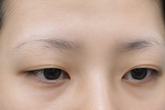 Eyebrow Hair Loss: Could It Be a Symptom of Seborrheic Dermatitis? Causes and How to Check image 1