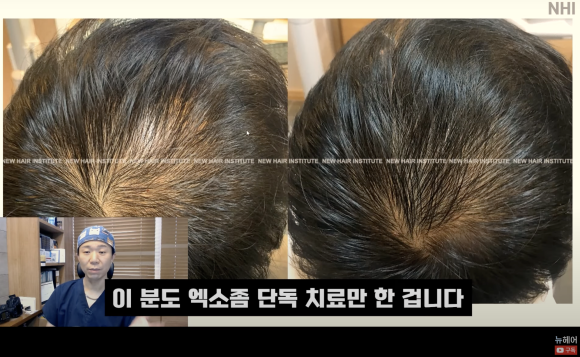 탈모치료 엑소좀, 엑소좀 뜻, 역할, 탈모 치료 효과ㅣ 정수리 탈모 ㅣ 전후사진 관련 이미지 15