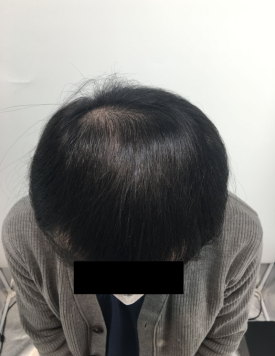 탈모치료주사? 효과 있을까 궁금하신 분들만 보세요 관련 이미지 6