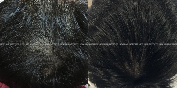 탈모치료 모낭주사 효과 l 정수리 탈모치료 후기 사진 관련 이미지 1