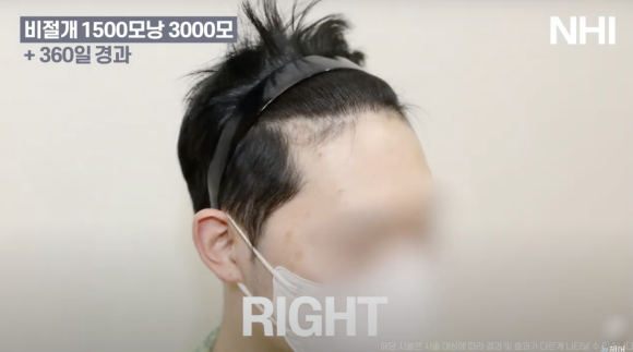 비절개 모발이식 후기 1년 사진 l 암흑기 지나고 후기 관련 이미지 4