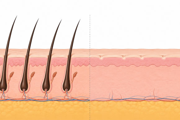 Is Hair Transplantation Possible After Laser Hair Removal? Confusing Myths and Facts image 3