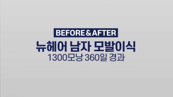 모발이식 전후 사진 l 1년 후ㅣ뉴헤어 1300모낭 관련 이미지 1