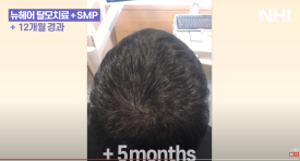 탈모치료(모낭주사) 1년 효과 l 뉴헤어 엑소좀 탈모치료 관련 이미지 5