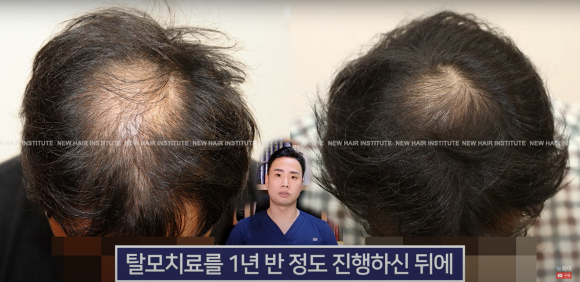 모발이식 알아봐야 한다면 관련 이미지 5