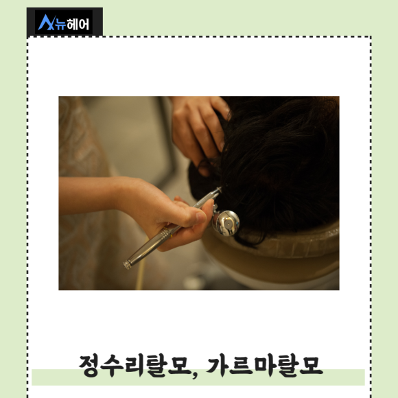 여자 정수리탈모치료 고민만 하지 말고 관련 이미지 3