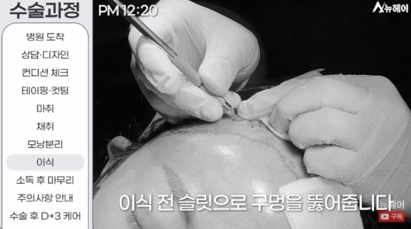 모발이식과정? A~Z 전부 공개합니다(동영상 포함) 관련 이미지 9