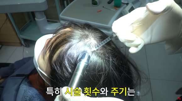 탈모 모낭주사 효과 진짜 있나요? (종류&middot;부작용) 관련 이미지 5