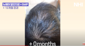 탈모치료(모낭주사) 1년 효과 l 뉴헤어 엑소좀 탈모치료 관련 이미지 3