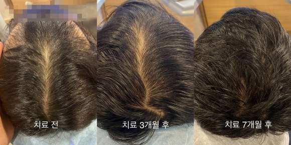 정수리 탈모치료(모낭주사/엑소좀) 3개월, 7개월 후기 사진 관련 이미지 1