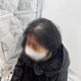 여성두피문신? 60대 실제 사례 사진으로 확인하세요 관련 이미지 7