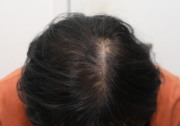 Why Are Crown Hair Transplants (Part-Line Hair Transplants) Slower to Show Results Than Other Areas? image 5