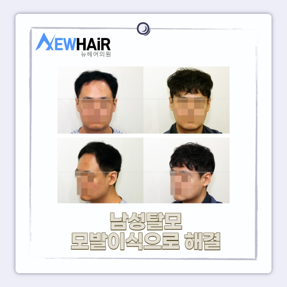 남성탈모 모발이식으로 해결 관련 이미지 1