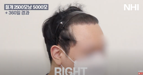 넓은 이마 모발이식 l 탈모 모발이식 후기 사진 관련 이미지 5