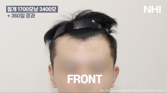 모발이식으로 엠자라인 벗어난 1년 후기 사진 l 1700모낭 이식 l 유전성탈모 관련 이미지 2