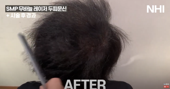 [뉴헤어] 두피문신 전후 빗질 영상 l 정수리 탈모 관련 이미지 4