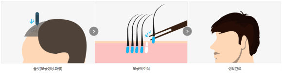 비절개 모발이식 흉터, 줄일 수 있는 노하우 1가지 관련 이미지 3