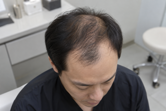 앞머리와 정수리가 같이 비었다면 어디부터 모발이식해야 할까? 관련 이미지 1