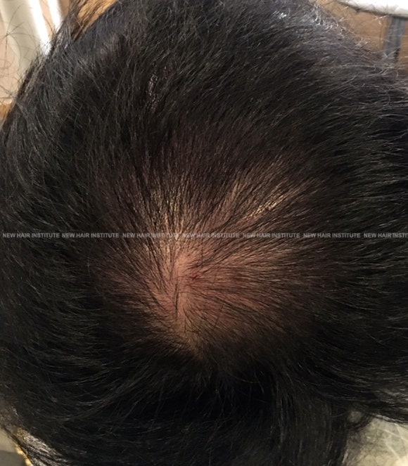 탈모 주사치료 FLEEX 효과 전후사진 비교 관련 이미지 3