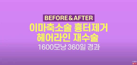 이마축소술 흉터제거 및 모발이식 전후 사진 ㅣ 이마축소 후 모발이식 관련 이미지 1