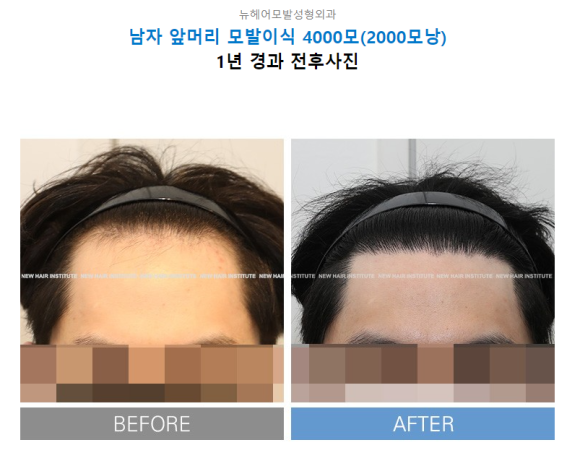 탈모약을 먹을까, 탈모시술을 받을까. 나에게 맞는 탈모 치료는? 관련 이미지 6