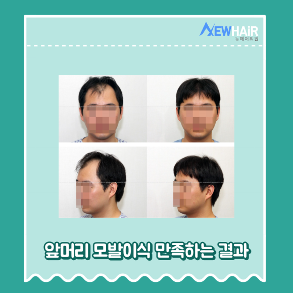 앞머리모발이식 만족하는 결과를 관련 이미지 5