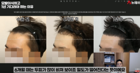 모발이식경과 1년을 기다려야 하는 이유 관련 이미지 13
