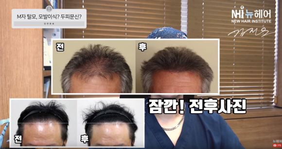 M자 탈모,  모발이식할까 두피문신할까 관련 이미지 2