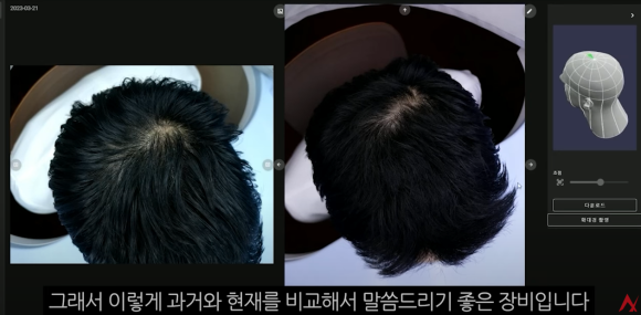 What Can Hair Loss Testing Tell Me About My Hair Loss Treatment? image 3
