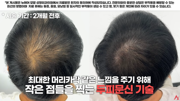 탈모커버 SMP두피문신, 두피페인팅(염색) 장단점 비교 관련 이미지 3