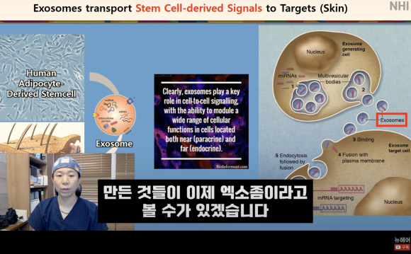 탈모치료 엑소좀, 엑소좀 뜻, 역할, 탈모 치료 효과ㅣ 정수리 탈모 ㅣ 전후사진 관련 이미지 9