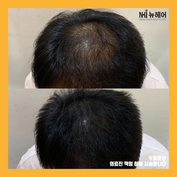 정수리 탈모 두피문신 전후 사진 모음 l 뉴헤어 관련 이미지 3