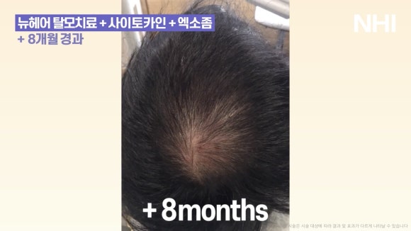 뉴헤어 탈모치료(모낭주사) 8개월 경과 사진 l 정수리탈모 관련 이미지 5