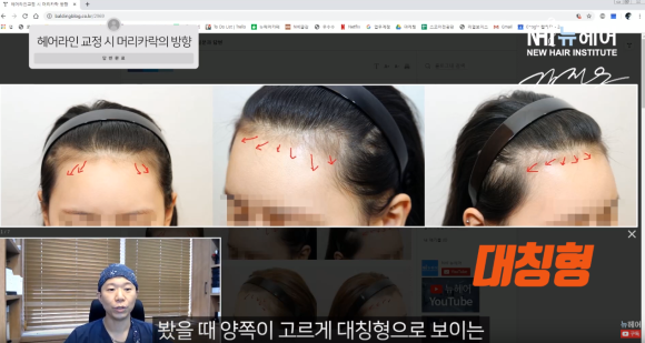 나도 몰랐던 머리카락 방향 찾기 l 모발이식 l 헤어라인교정 관련 이미지 2