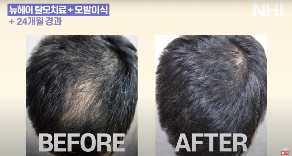 정수리 탈모 치료 l 탈모치료 후기ㅣ모낭주사 효과 1년 후 관련 이미지 1