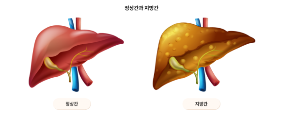 Is It True That Fatty Liver Raises the Risk of Hair Loss? image 1